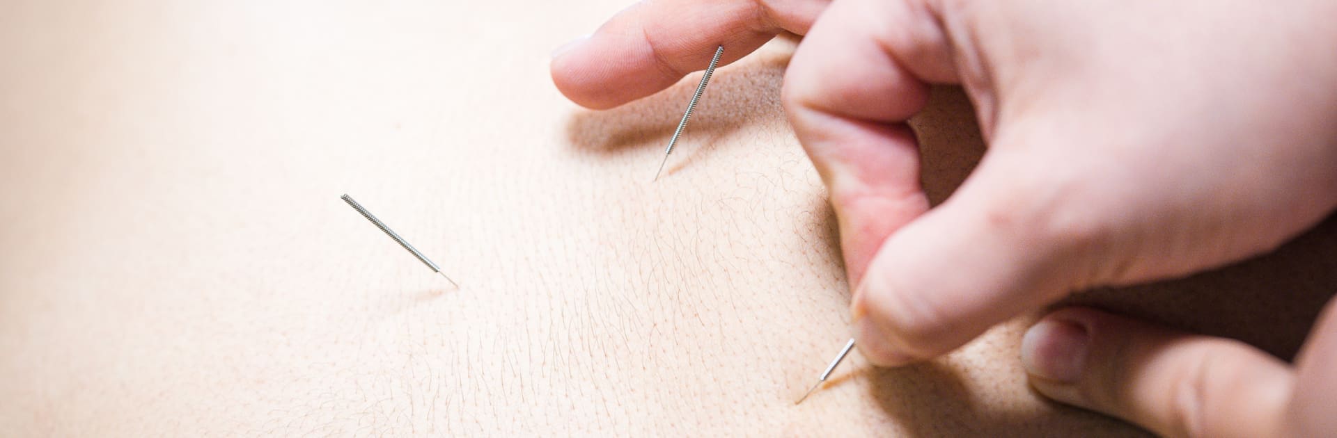 Dry Needling i Trollhättan, Uddevalla, Ljungskile